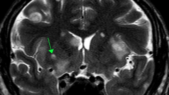 Imagem de ressonância magnética feita no cérebro 
